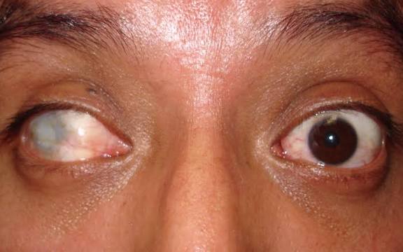 Prosthetic Lens for Demage Eye