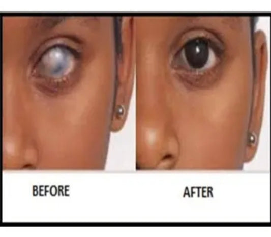 Prosthetic Lens for Demage Eye